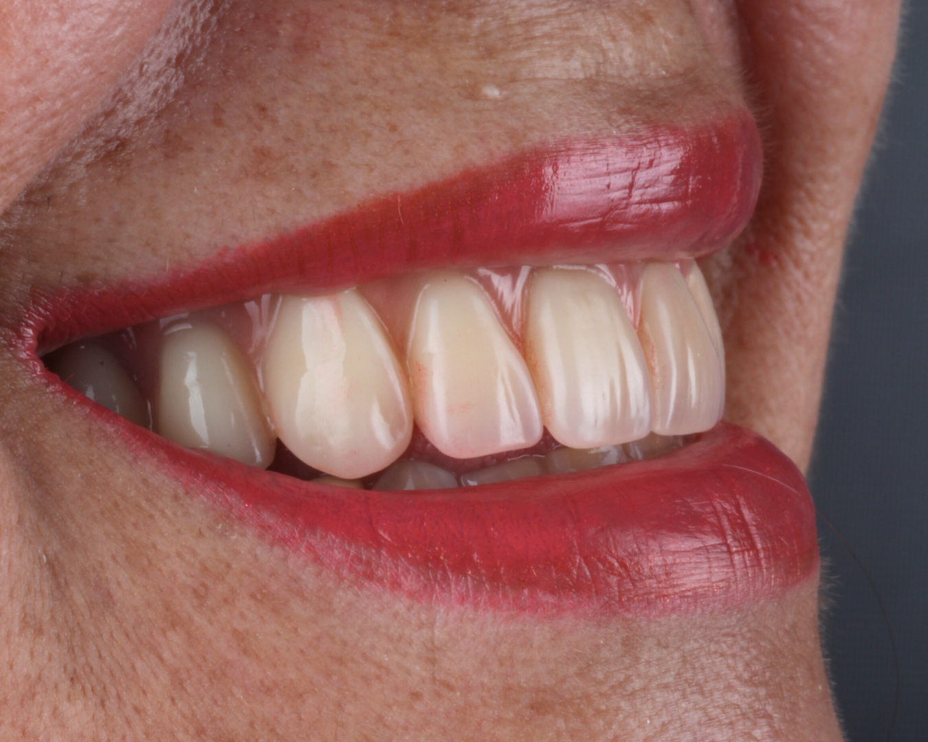 Depois - after smile