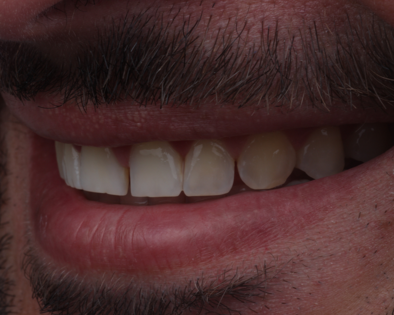 Antes - before smile