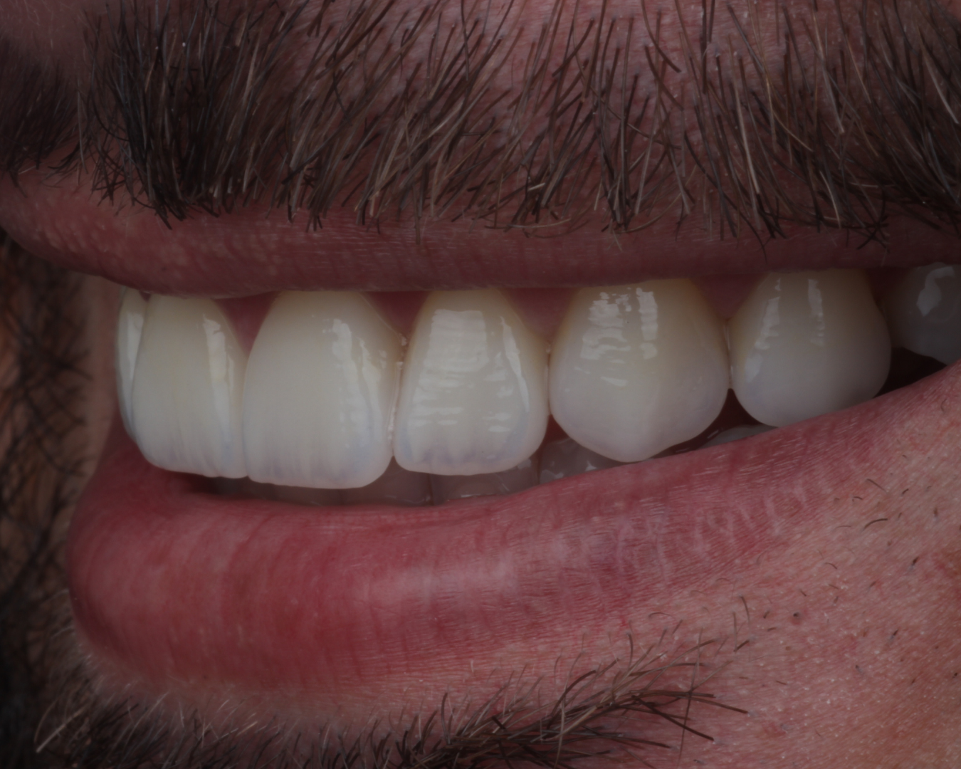 Depois - after smile