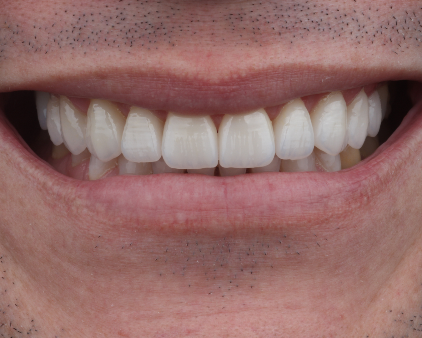 Depois - after smile