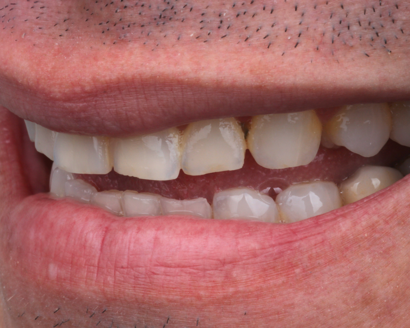 Antes - before smile