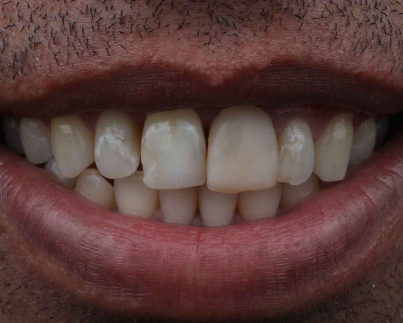 Antes - before smile