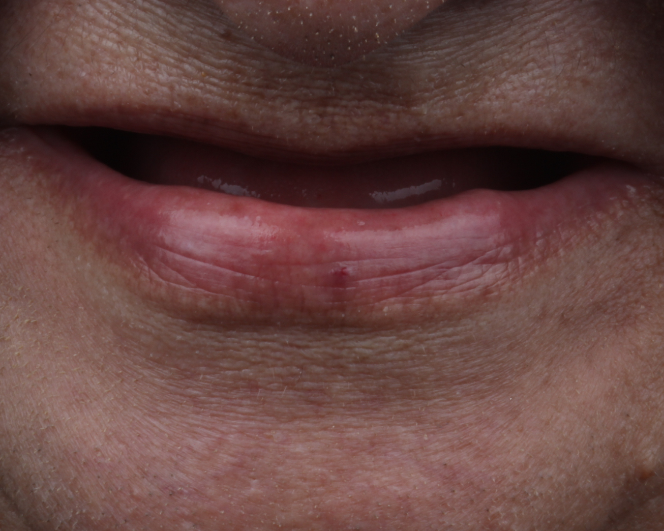 Antes - before smile