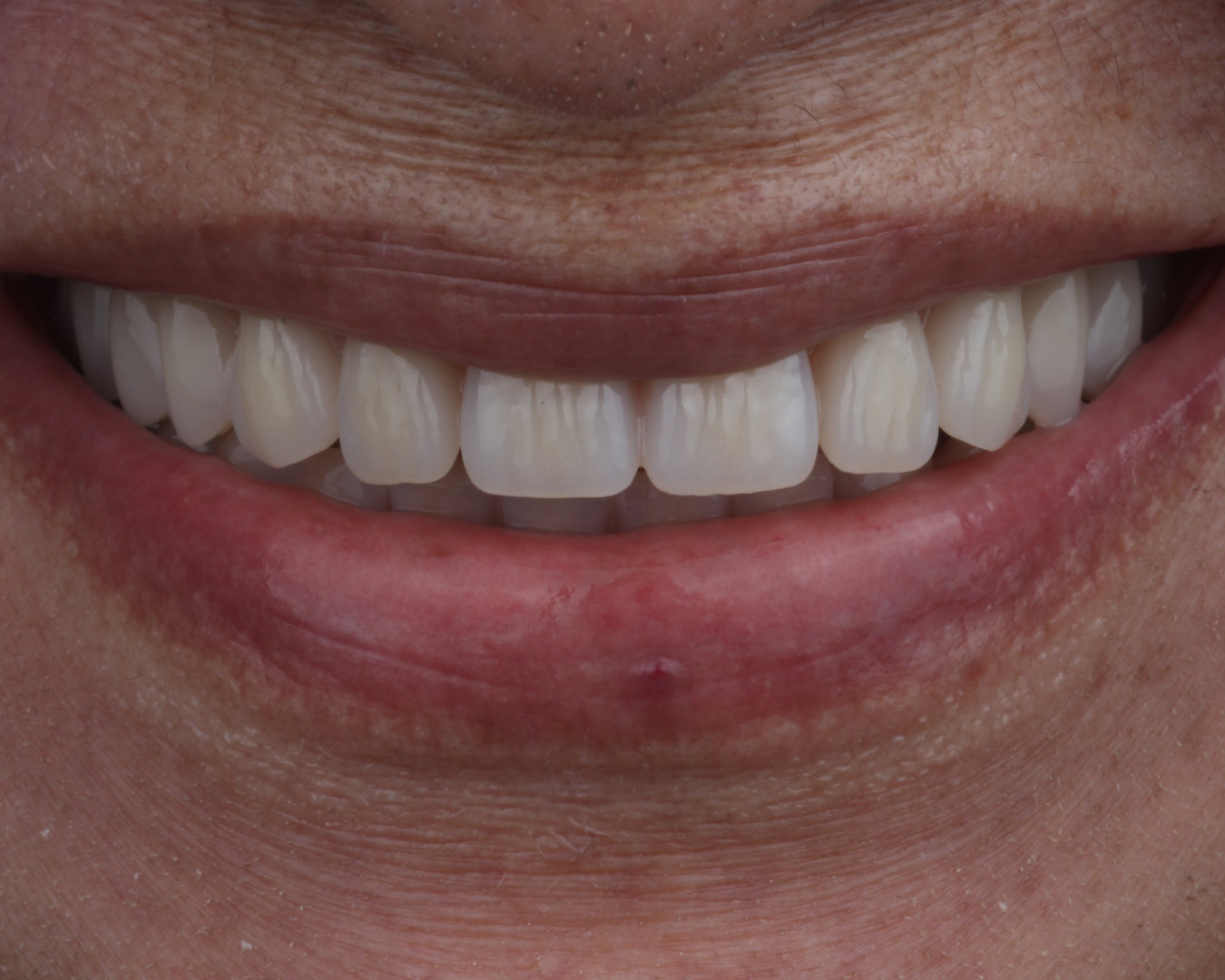 Depois - after smile