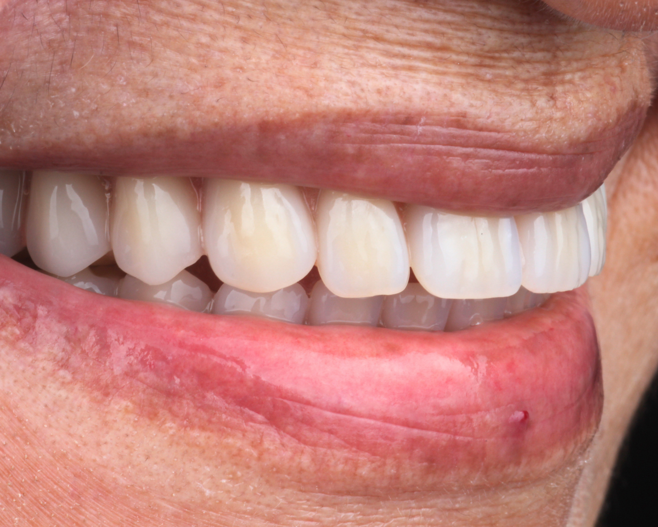 Depois - after smile