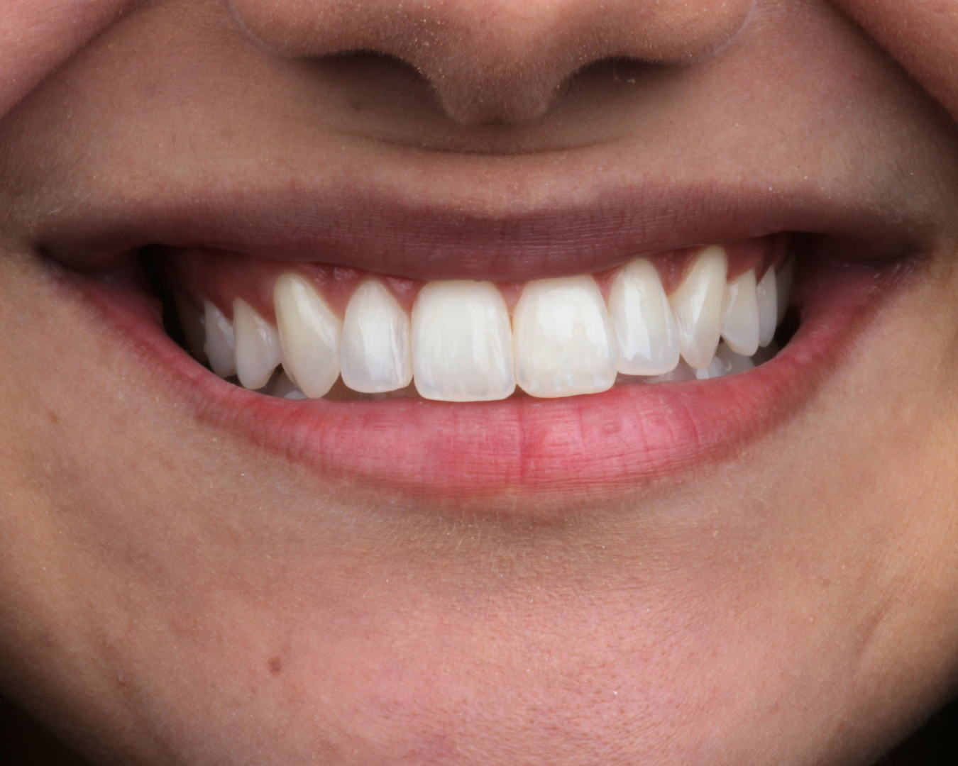 Depois - after smile