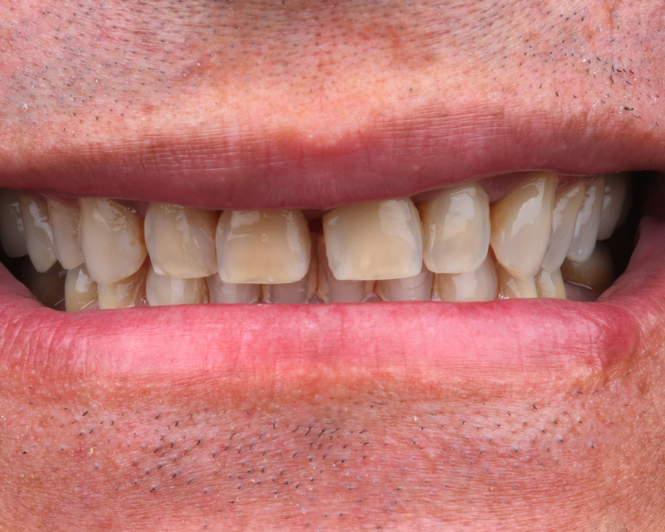 Antes - before smile