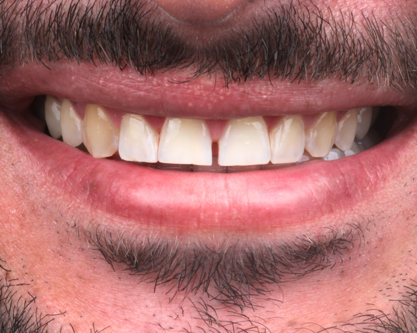 Antes - before smile