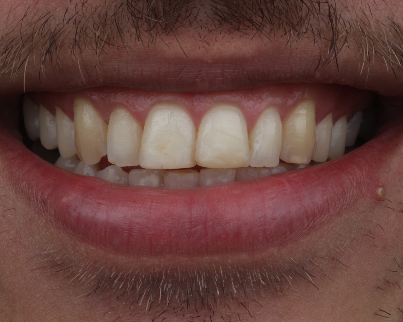 Antes - before smile