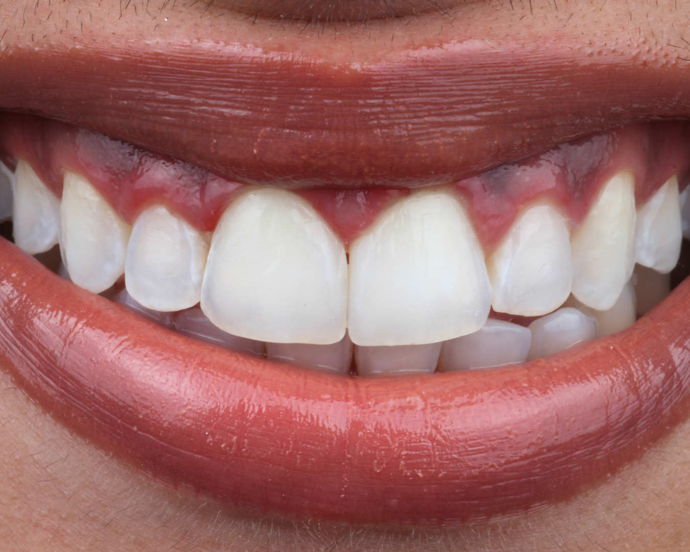 Depois - after smile