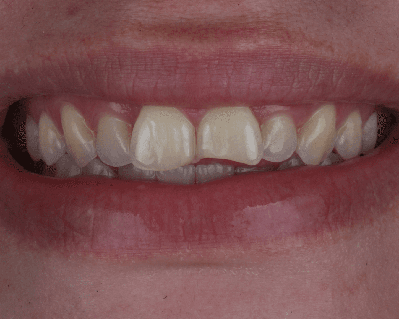 Antes - before smile