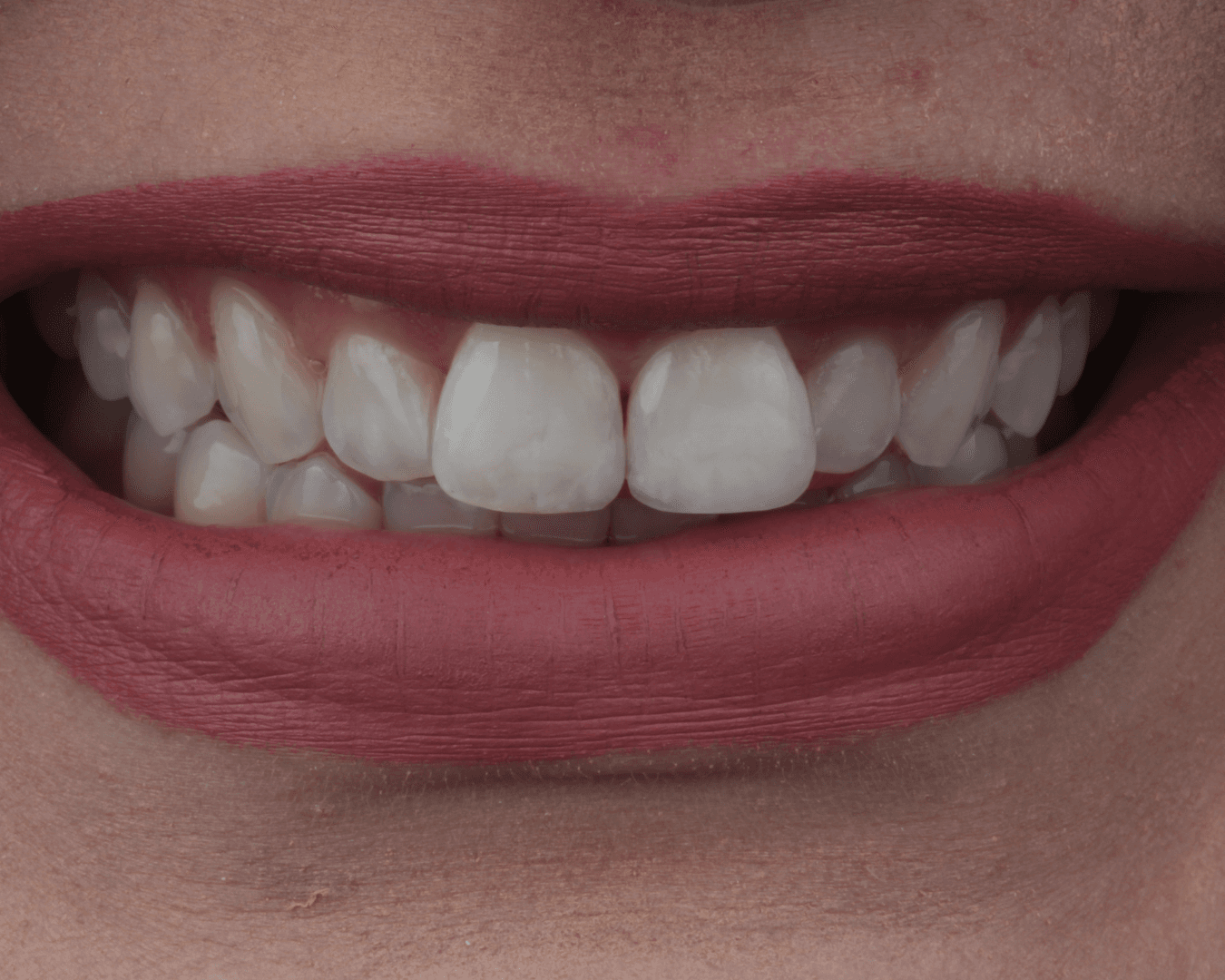 Depois - after smile