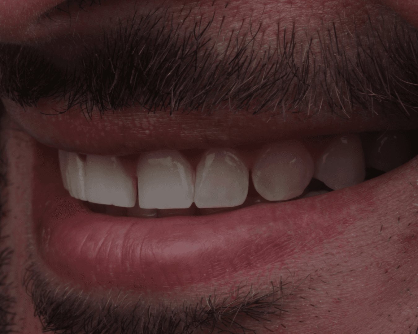 Antes - before smile