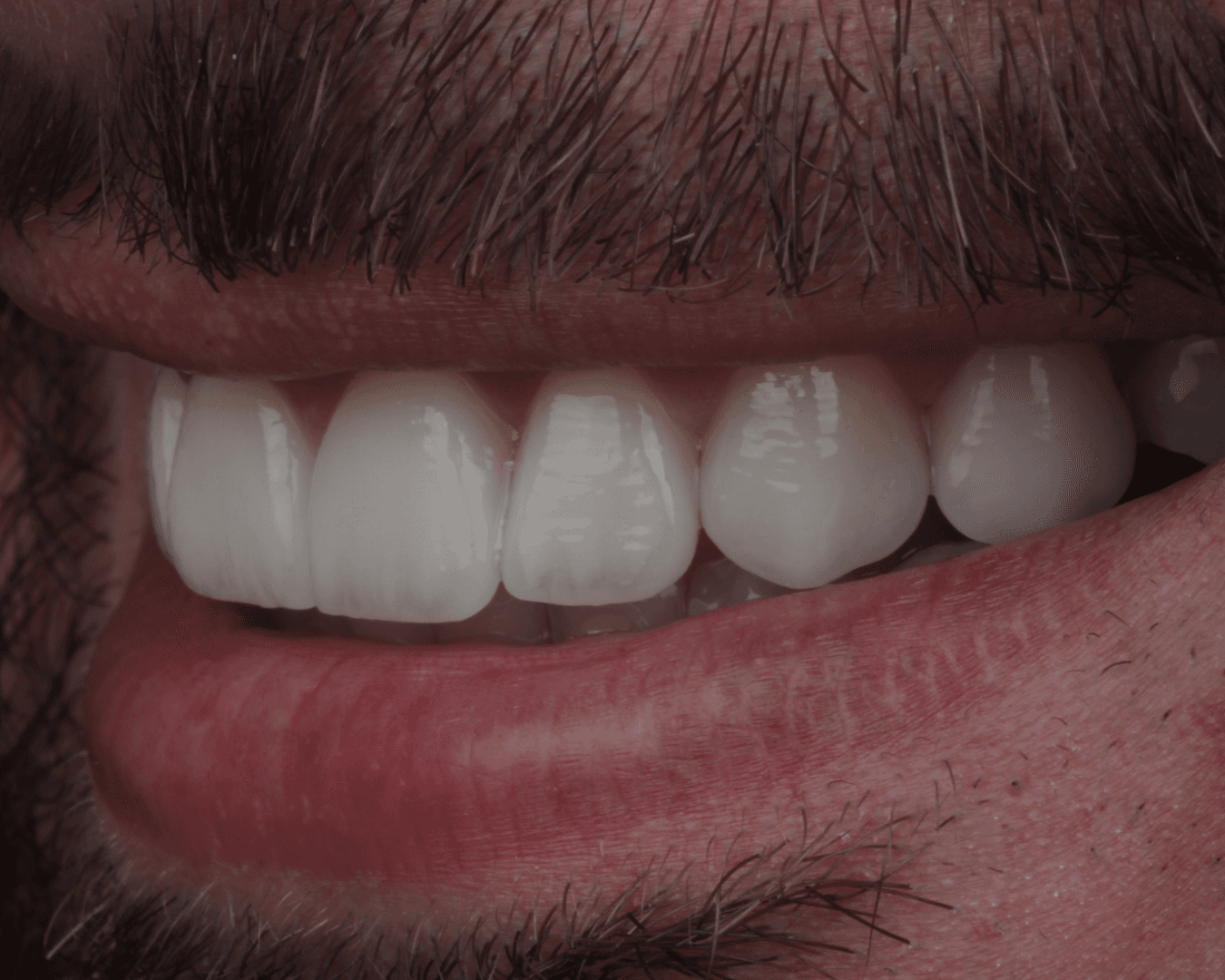 Depois - after smile