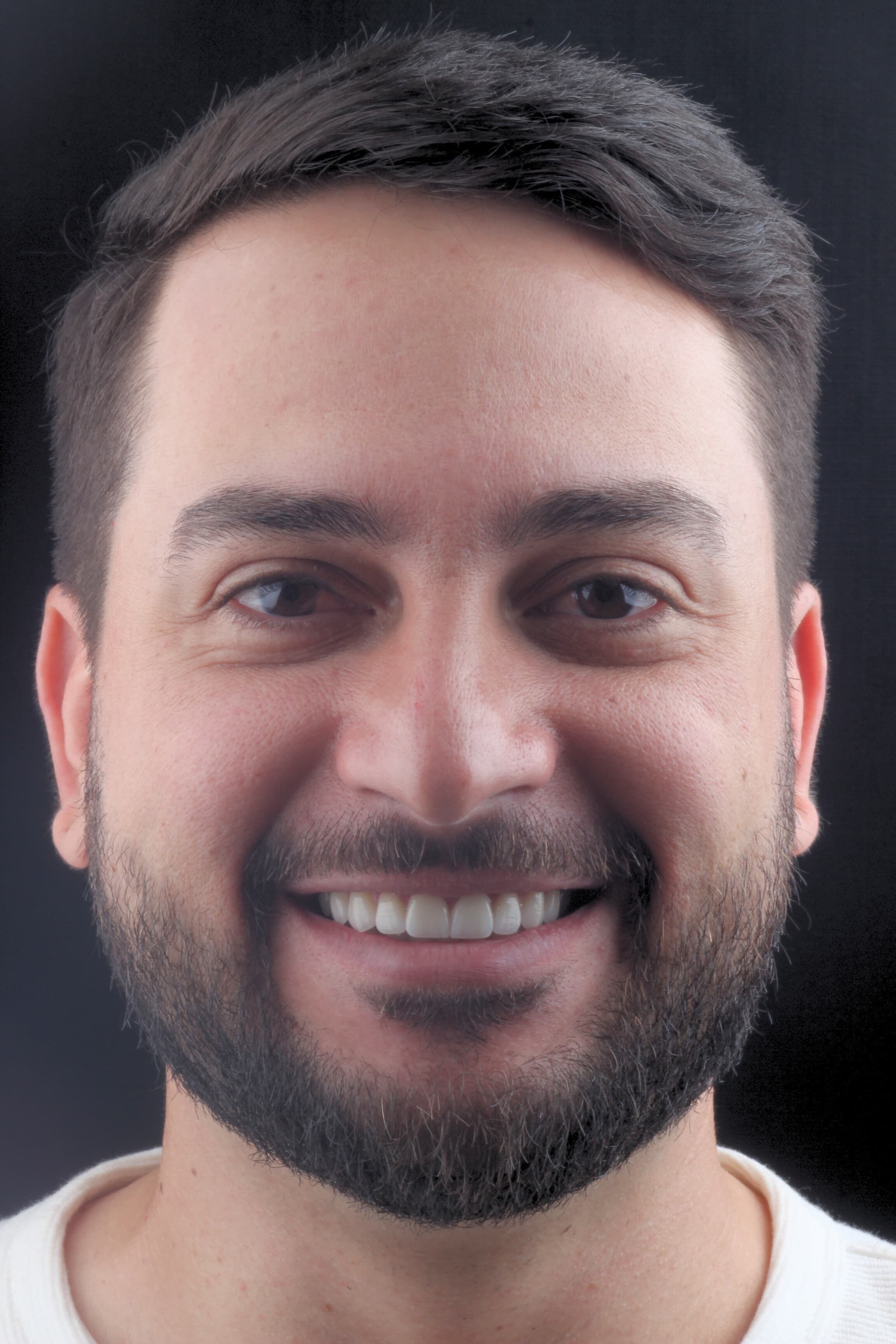 Estética Avançada (Lentes de Contato, Facetas e Coroas)