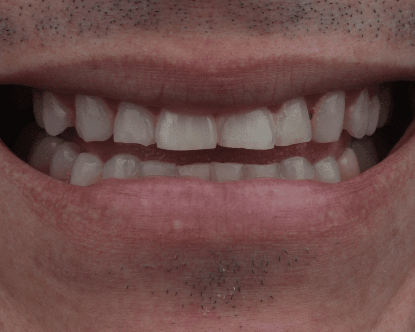 Antes - before smile