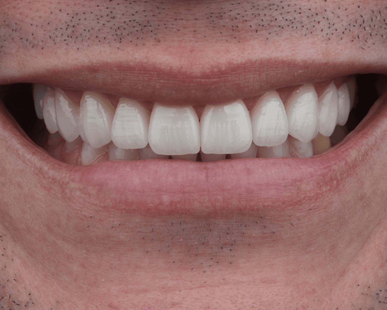 Depois - after smile