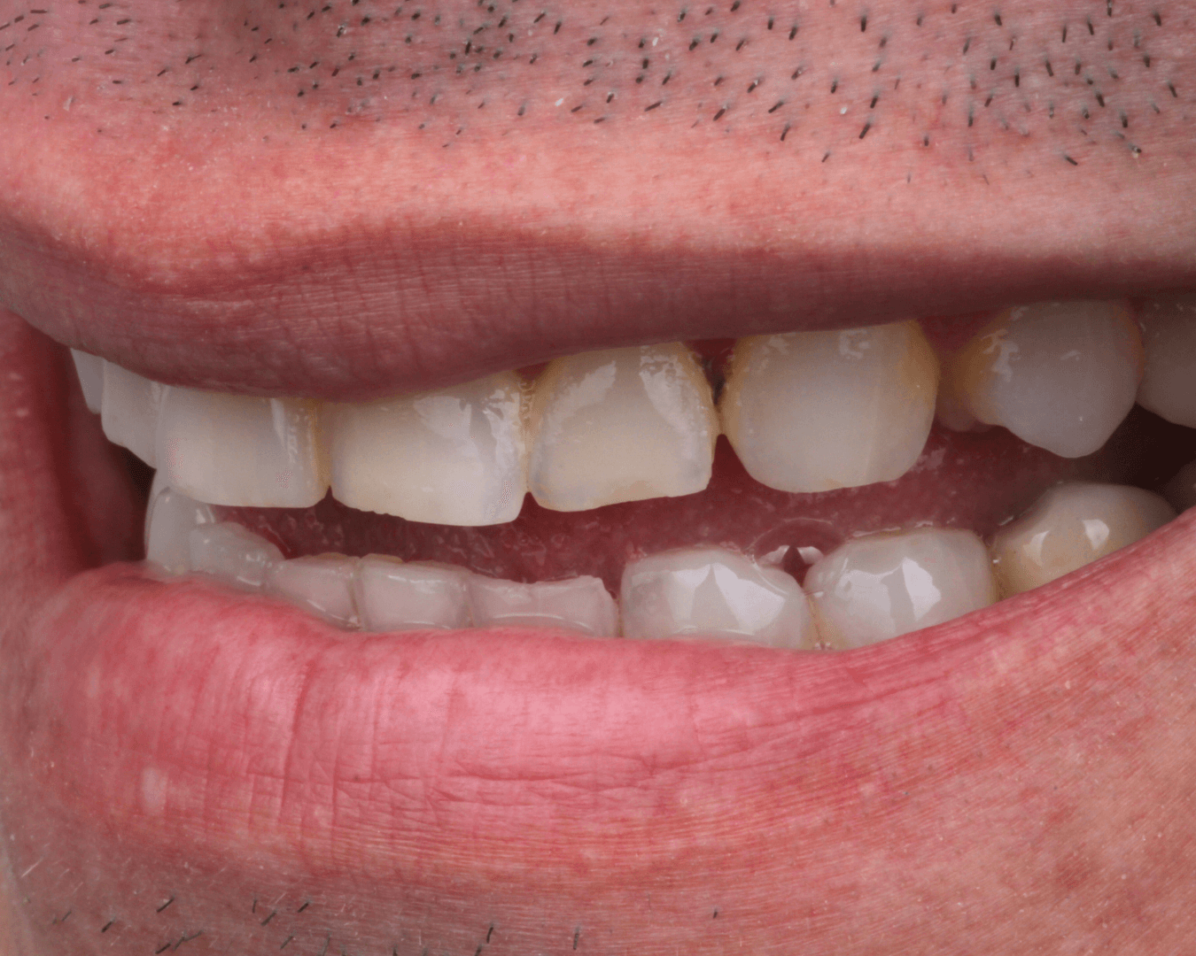 Antes - before smile