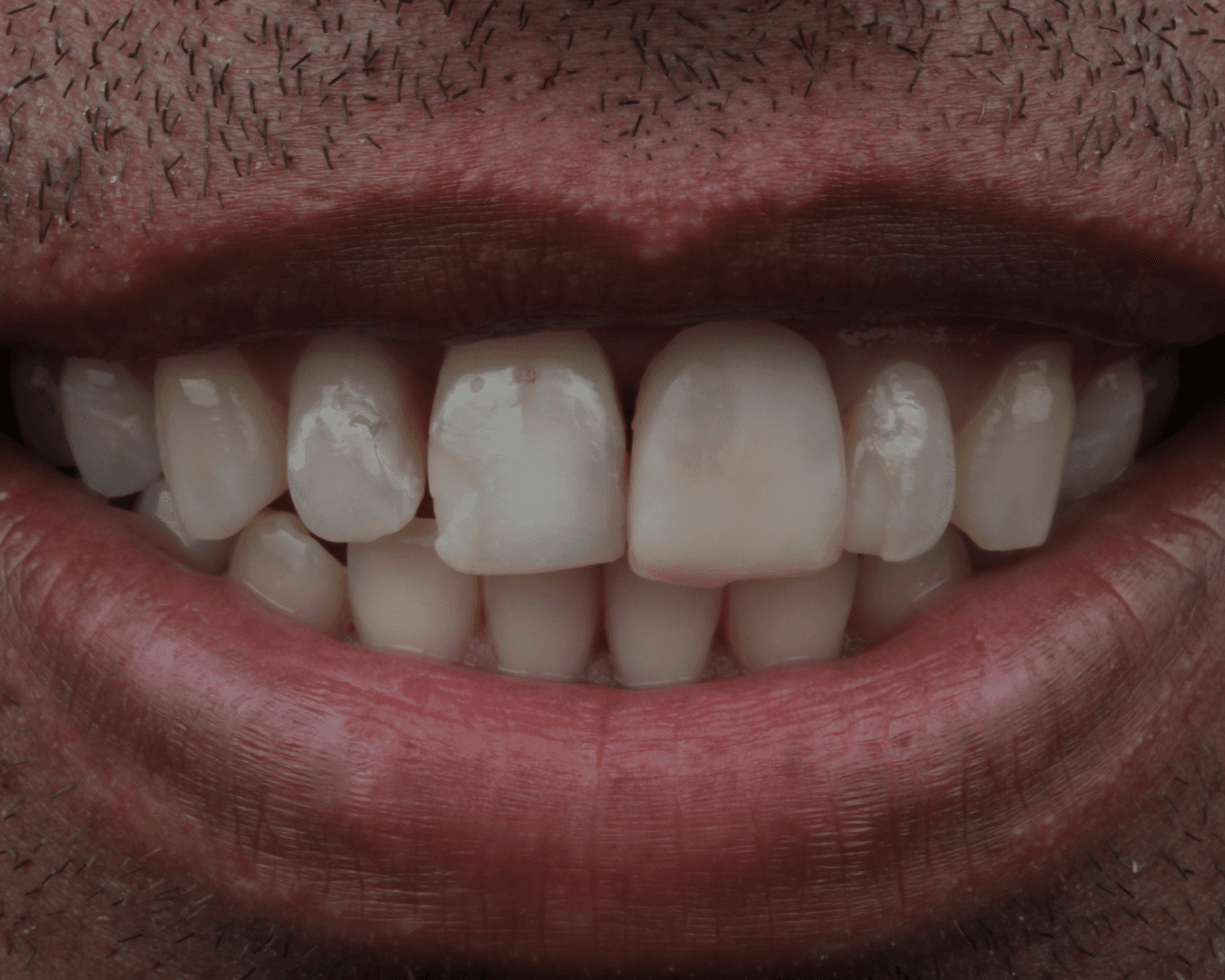 Antes - before smile