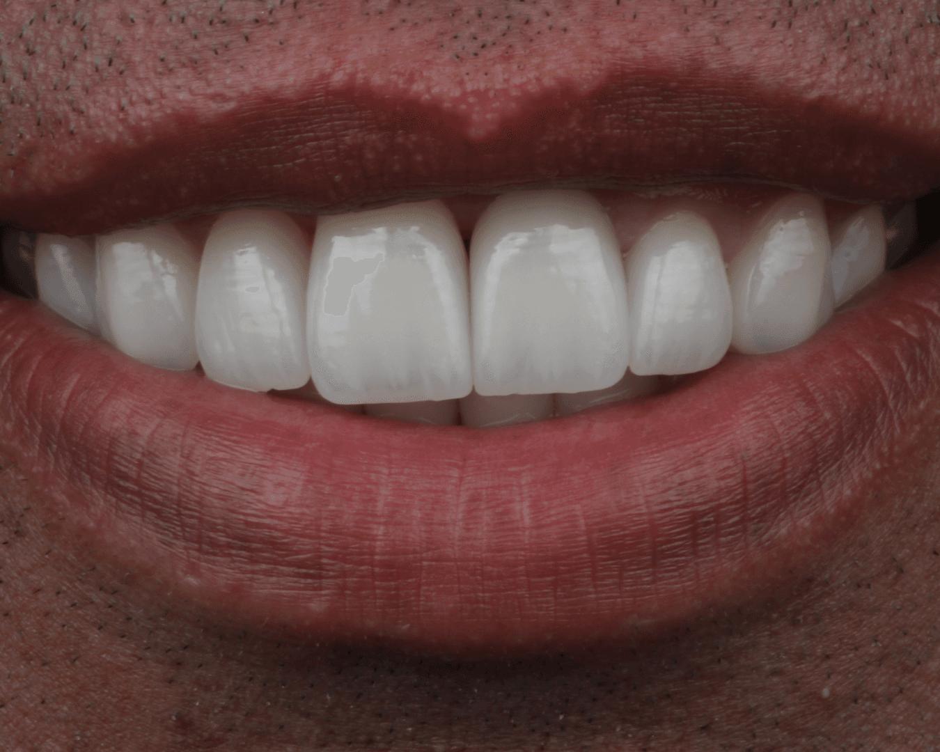 Depois - after smile