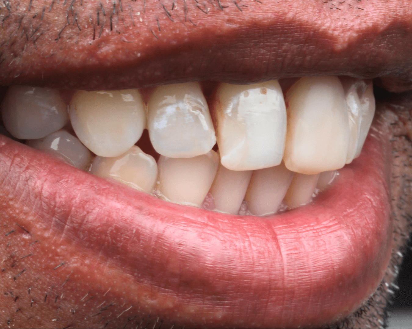 Antes - before smile