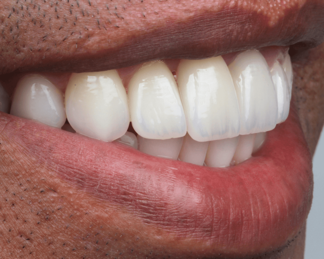 Depois - after smile