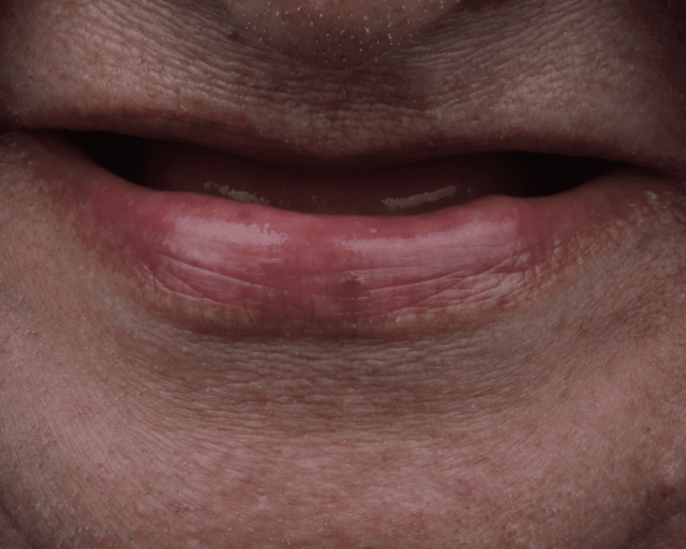 Antes - before smile