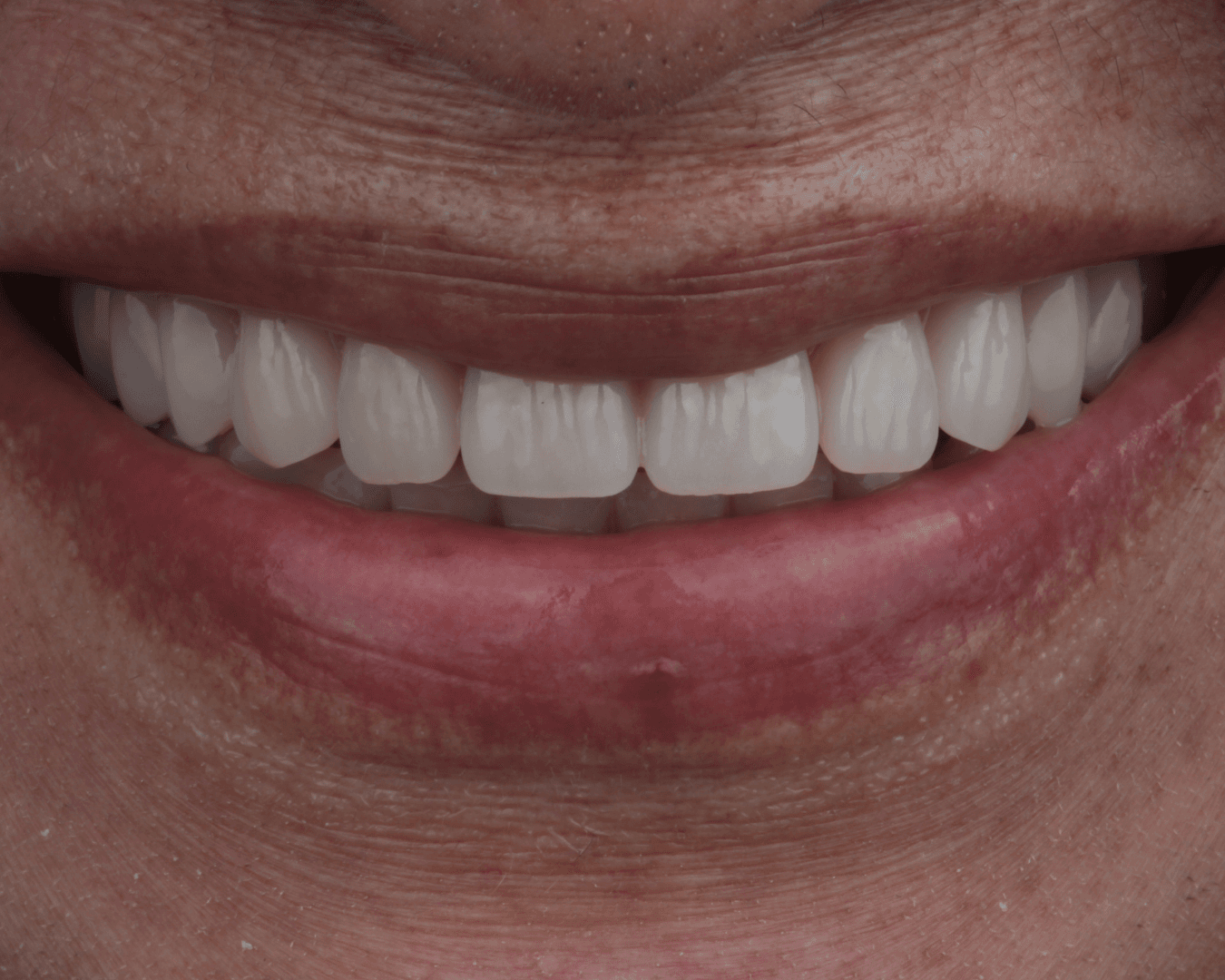 Depois - after smile