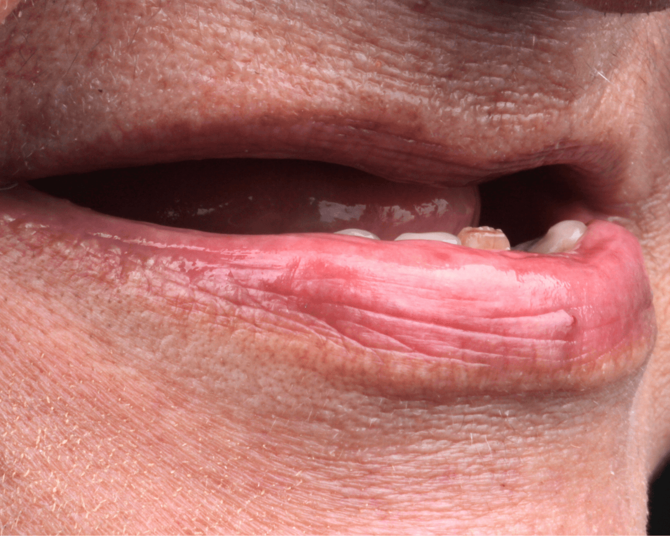 Antes - before smile