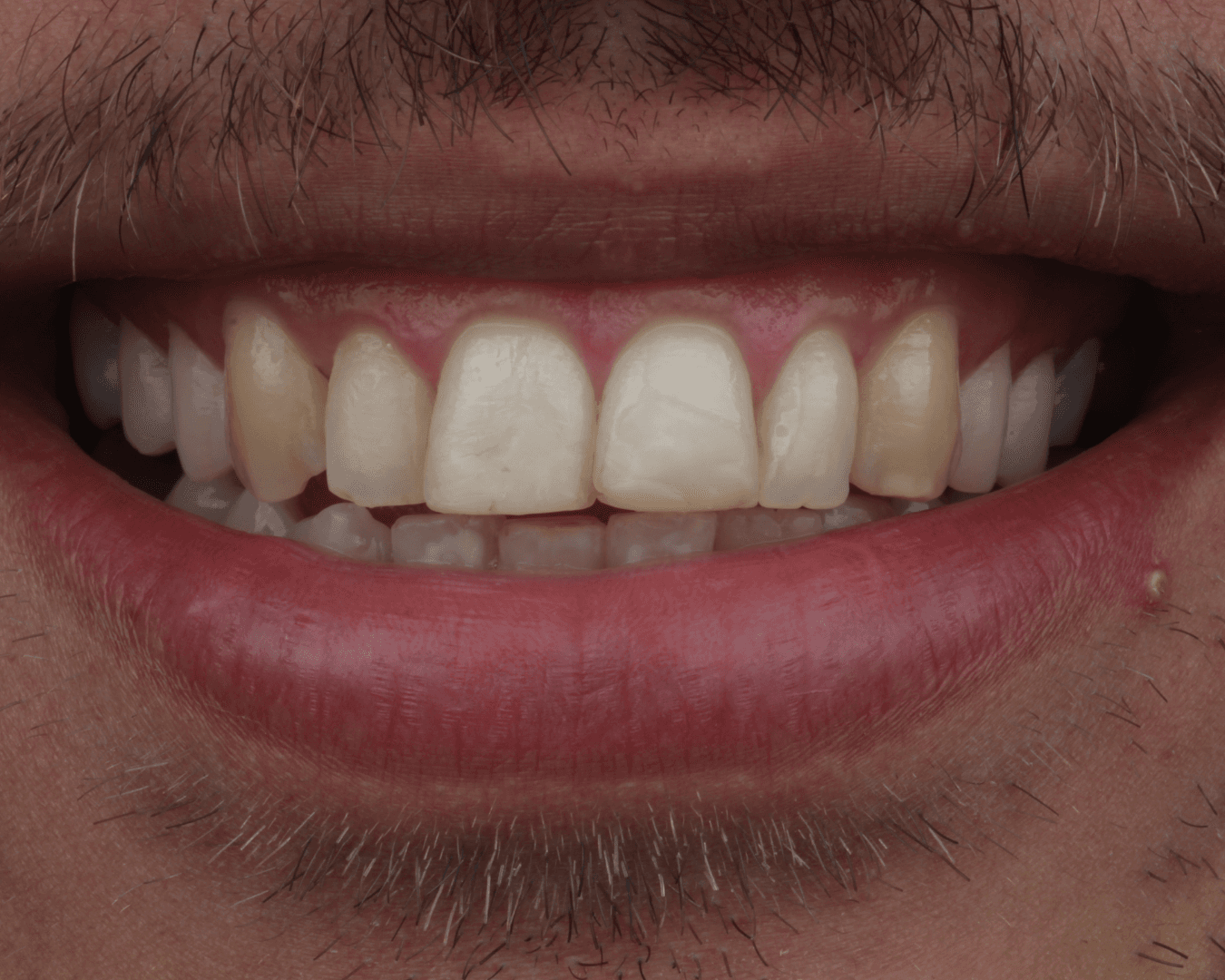 Antes - before smile