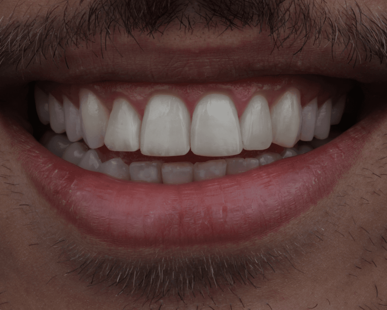 Depois - after smile