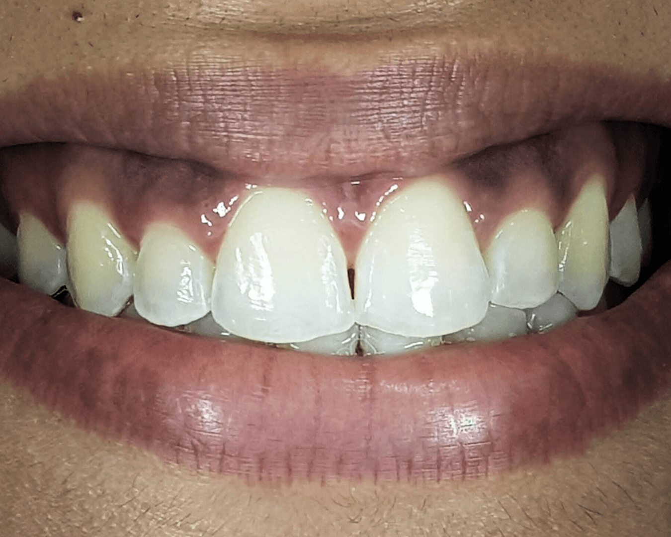 Antes - before smile