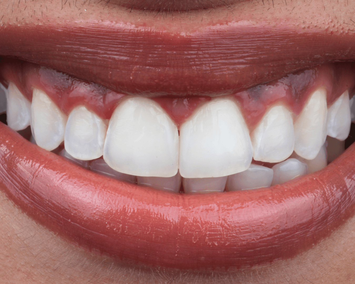 Depois - after smile